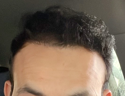FUE hair transplant after